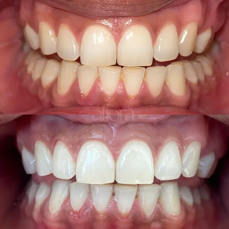 Blanqueamiento dental Afiora Resultado real de blanqueamiento dental en Afiora Clínica Estética Facial y Dental